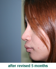 plastic_surgery_augmentation_rhinoplasty